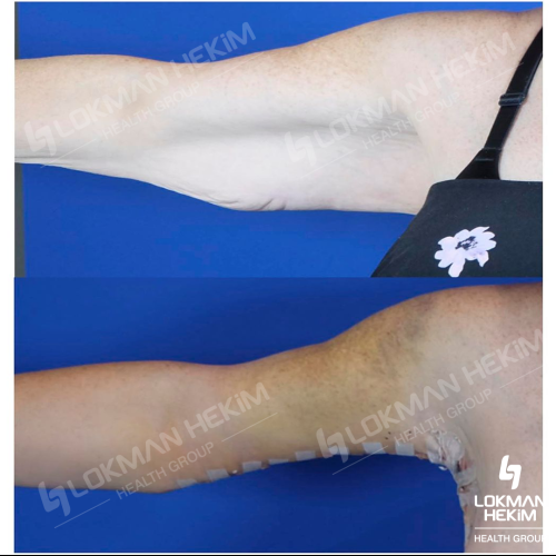 Брахиопластика Фотографии до и после